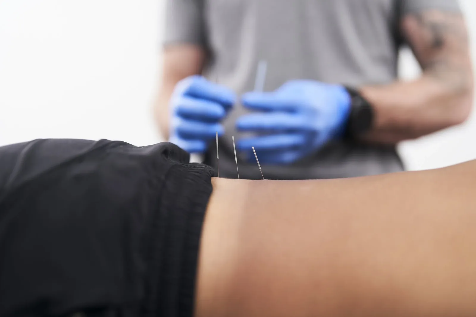 Functional dry needling treatment at Baillargeon Health and Fitness